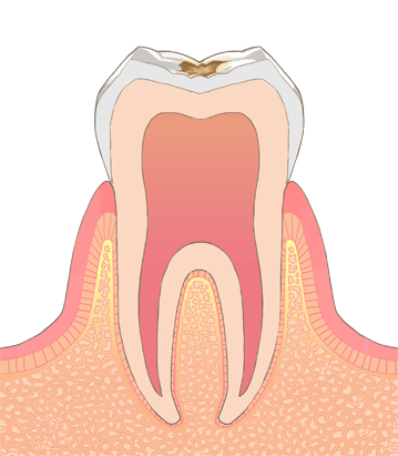 虫歯治療2