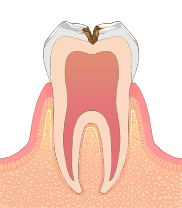 虫歯治療3