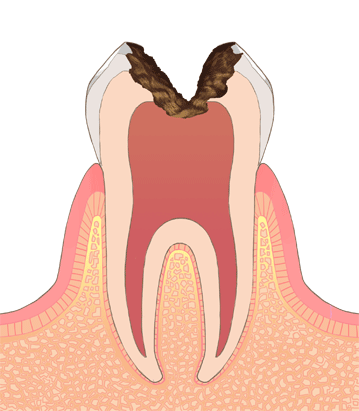 虫歯治療4