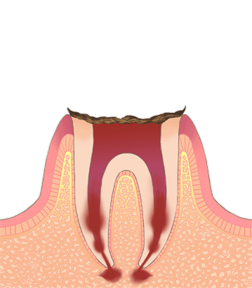 C4（歯根にまで達した虫歯）
