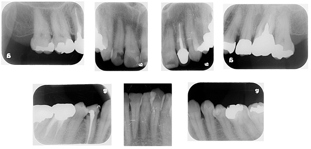 レントゲン検査