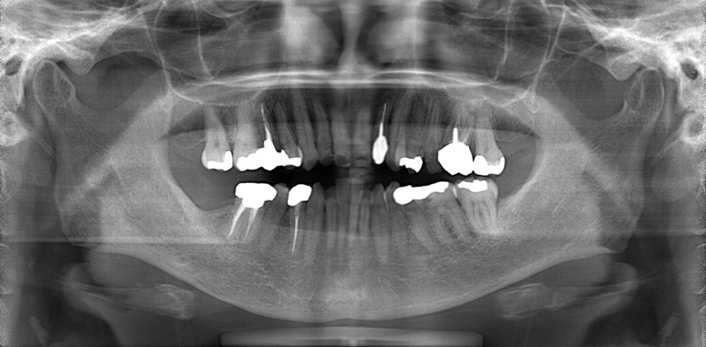 レントゲン検査